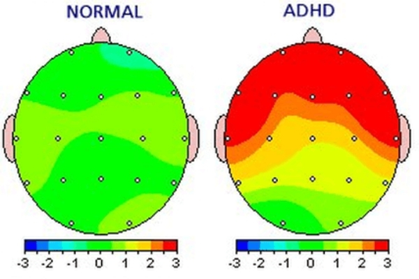 ADHD Image 3