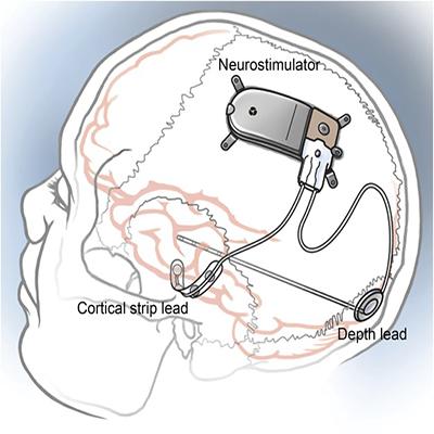 NeuroPaceINC 400px